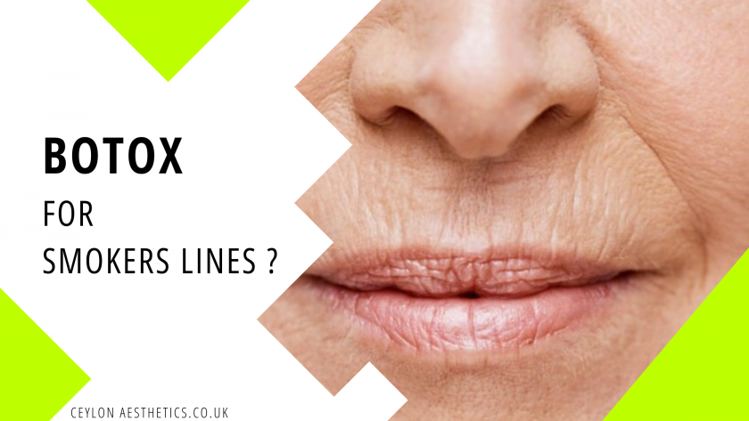 Smokers Lines Botox