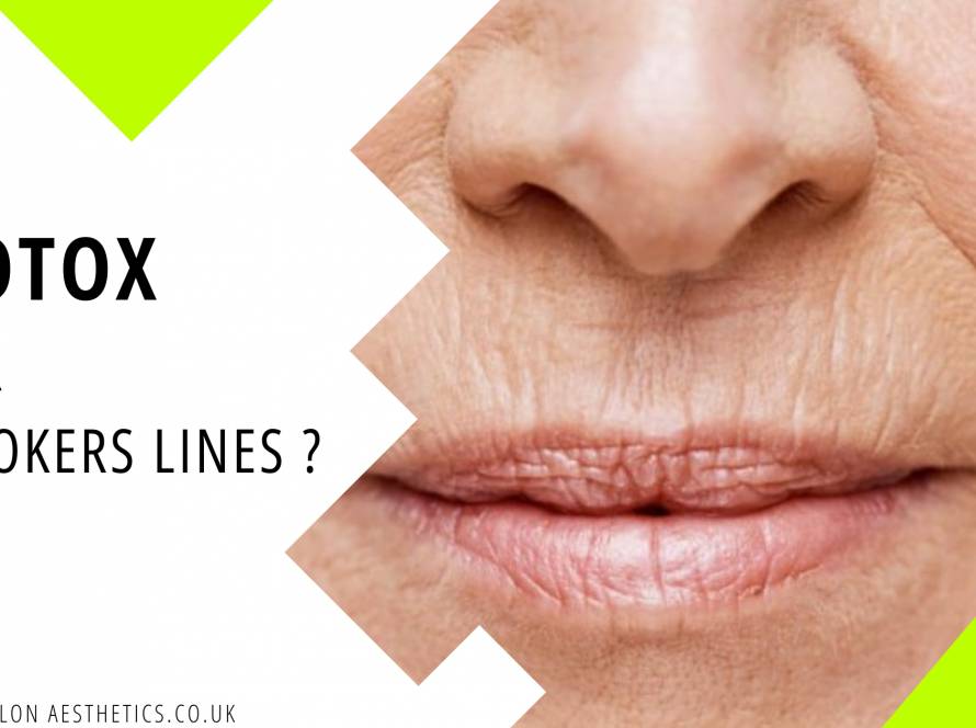 blog post botox smokers lines anti wrinkle injections